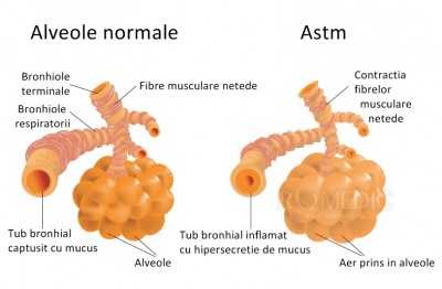 Astmul Bronsic